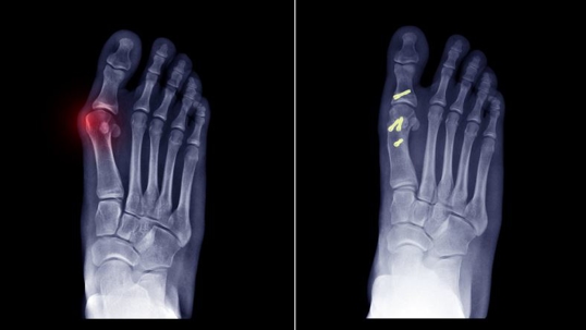 Foot xray