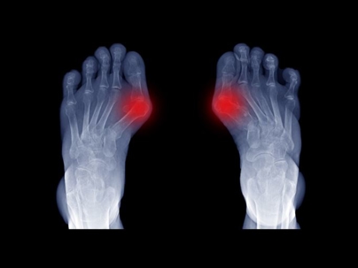 Foot Xray of Big Toe Arthritis
